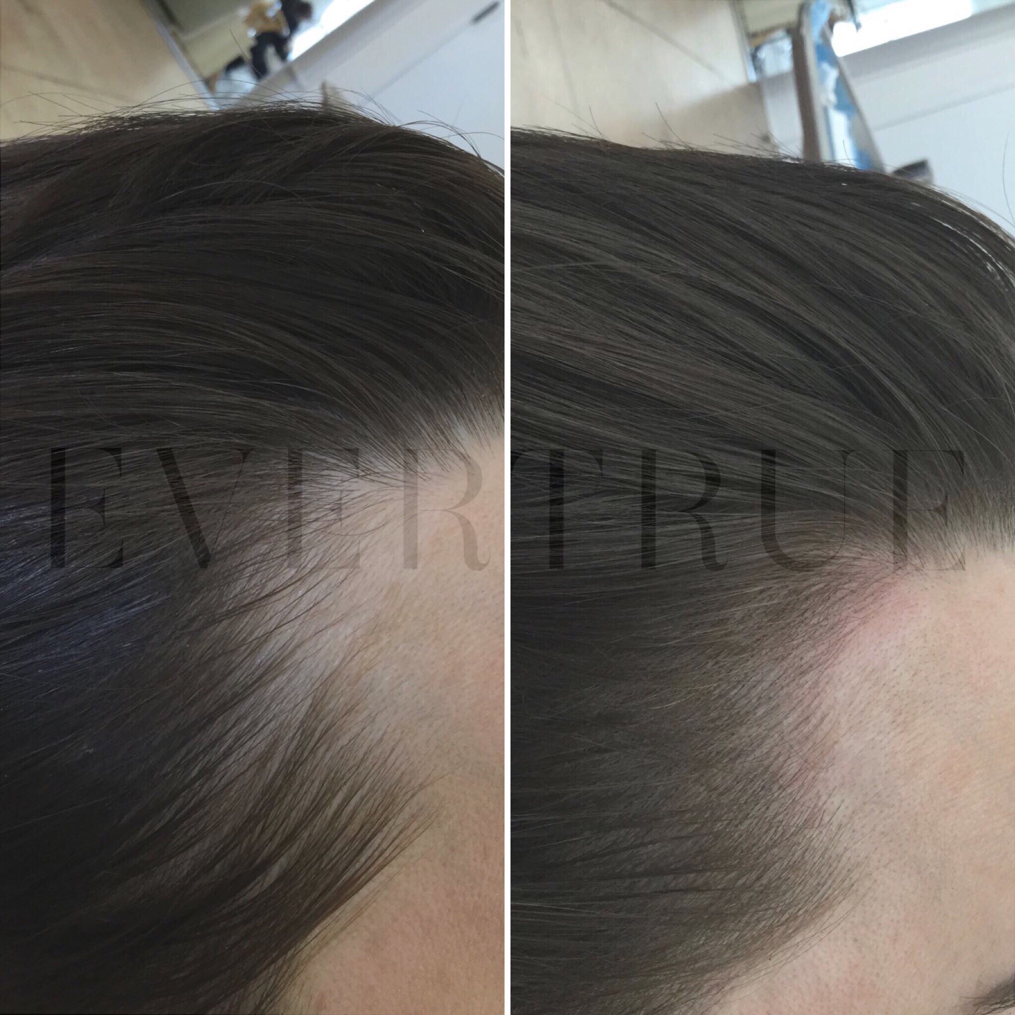 Side-by-side comparison of a person's hairline before and after a hair restoration procedure, showing a visibly fuller hairline in the after image.