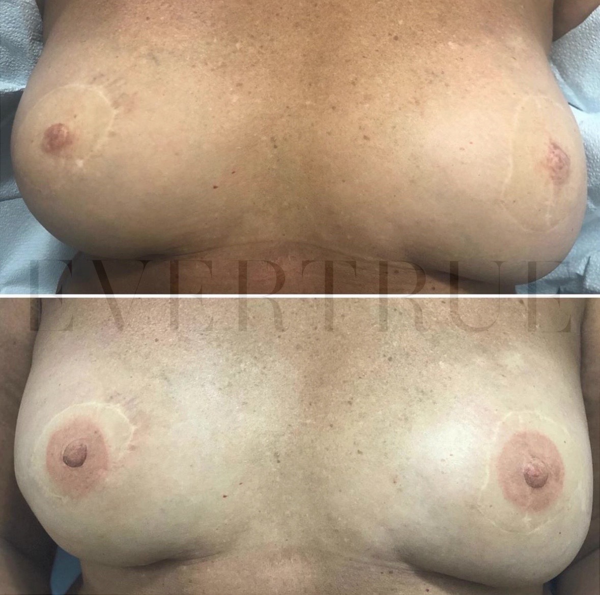 Before and after photo showing a person's chest with noticeable changes in areola appearance and scarring, likely following a cosmetic or reconstructive procedure.