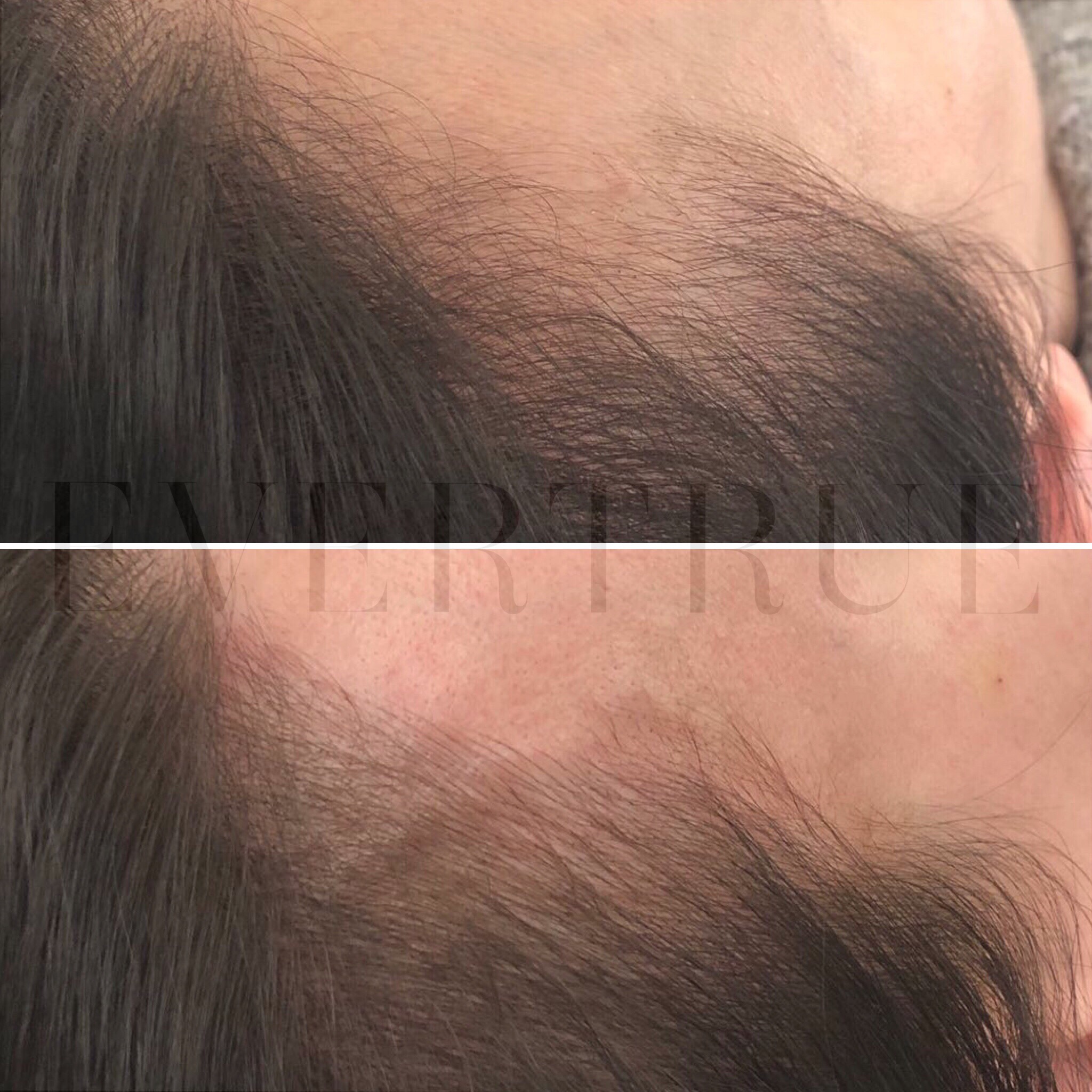 Close-up before-and-after images of a person's scalp showing increased hair density in the after photo, indicating hair restoration or treatment results.