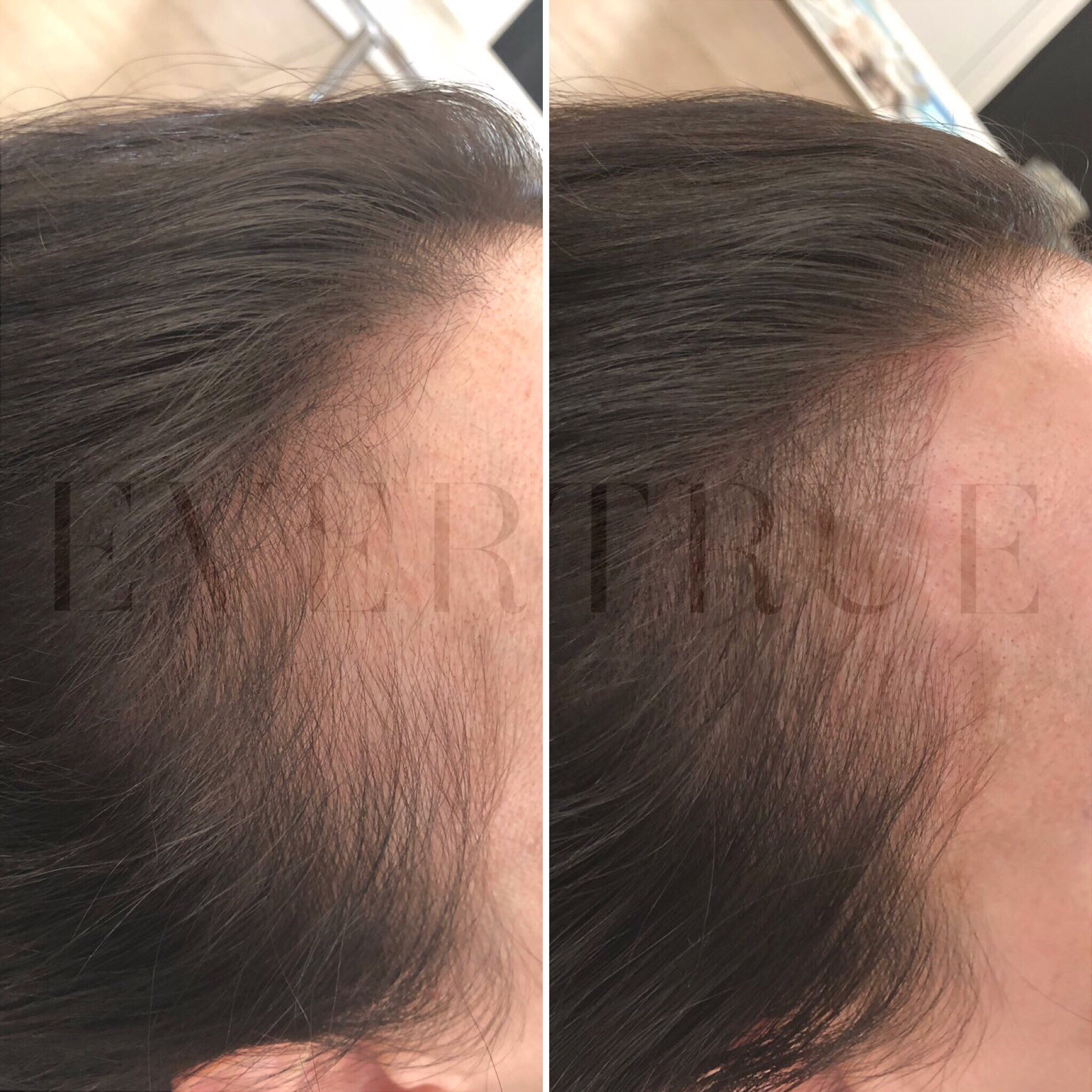 Side-by-side comparison of a person's hairline before and after a hair restoration treatment, showing fuller hair growth along the hairline in the after image.