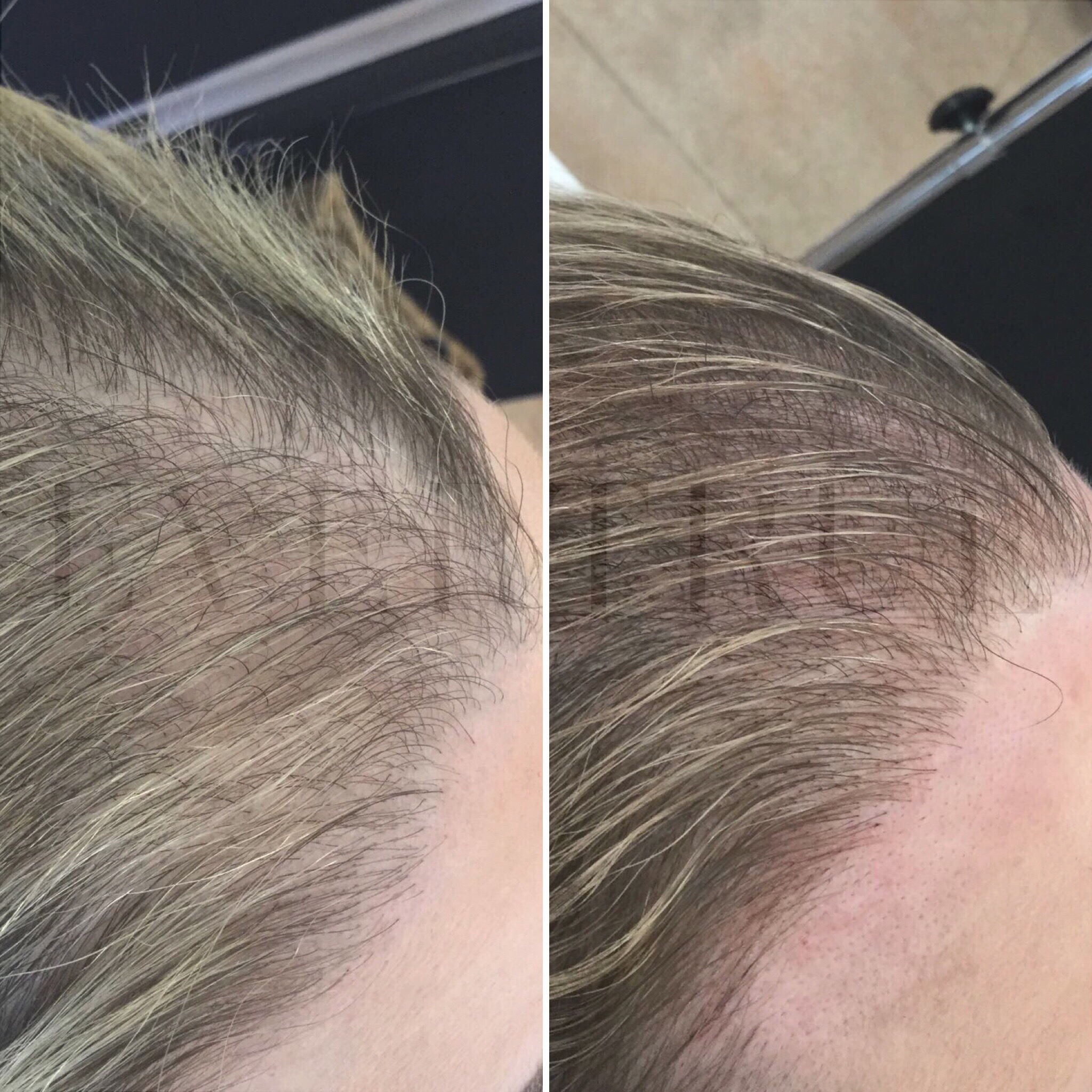 Side-by-side images show a person's hairline before and after a treatment; the second image displays a fuller, more defined hairline compared to the first.