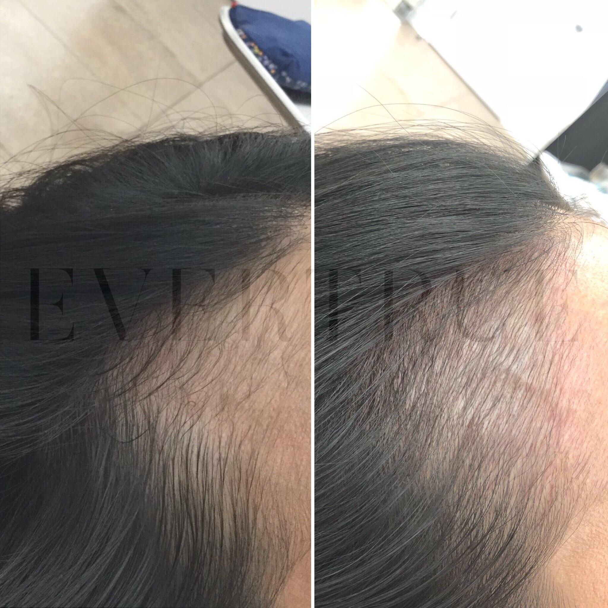 Close-up comparison of a person's hairline showing thinning hair on the left and fuller hair on the right, indicating hair regrowth or treatment results.