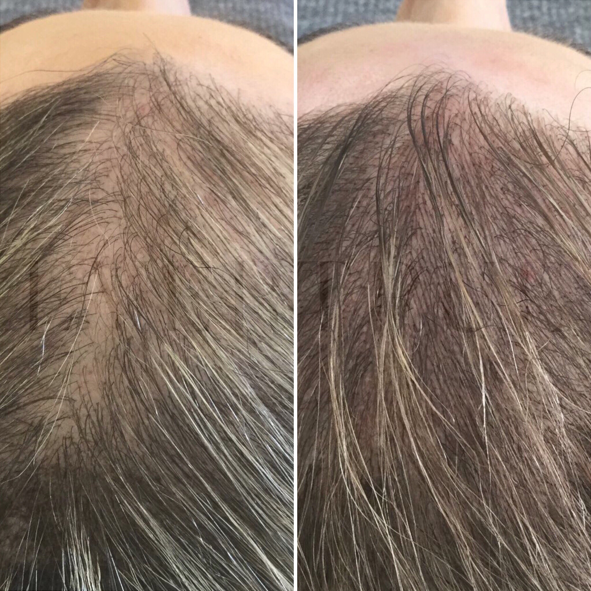 Side-by-side comparison of a scalp with thinning hair on the left and visibly thicker hair growth on the right.
