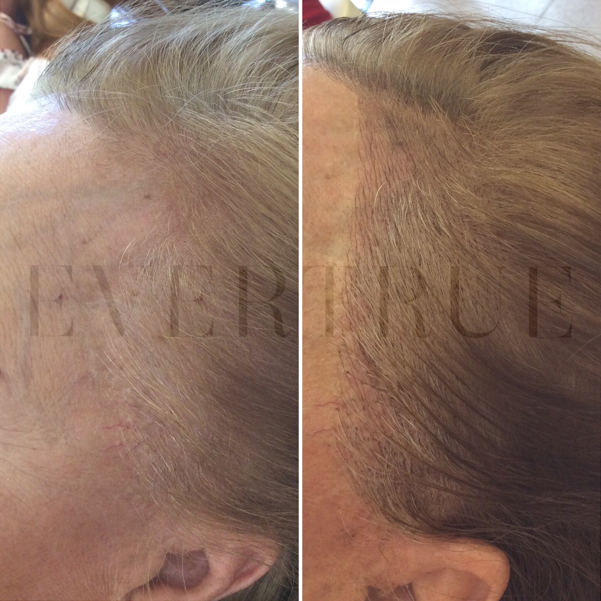 Side-by-side close-up of a person's hairline before and after a hair restoration treatment, showing increased hair density in the after image.