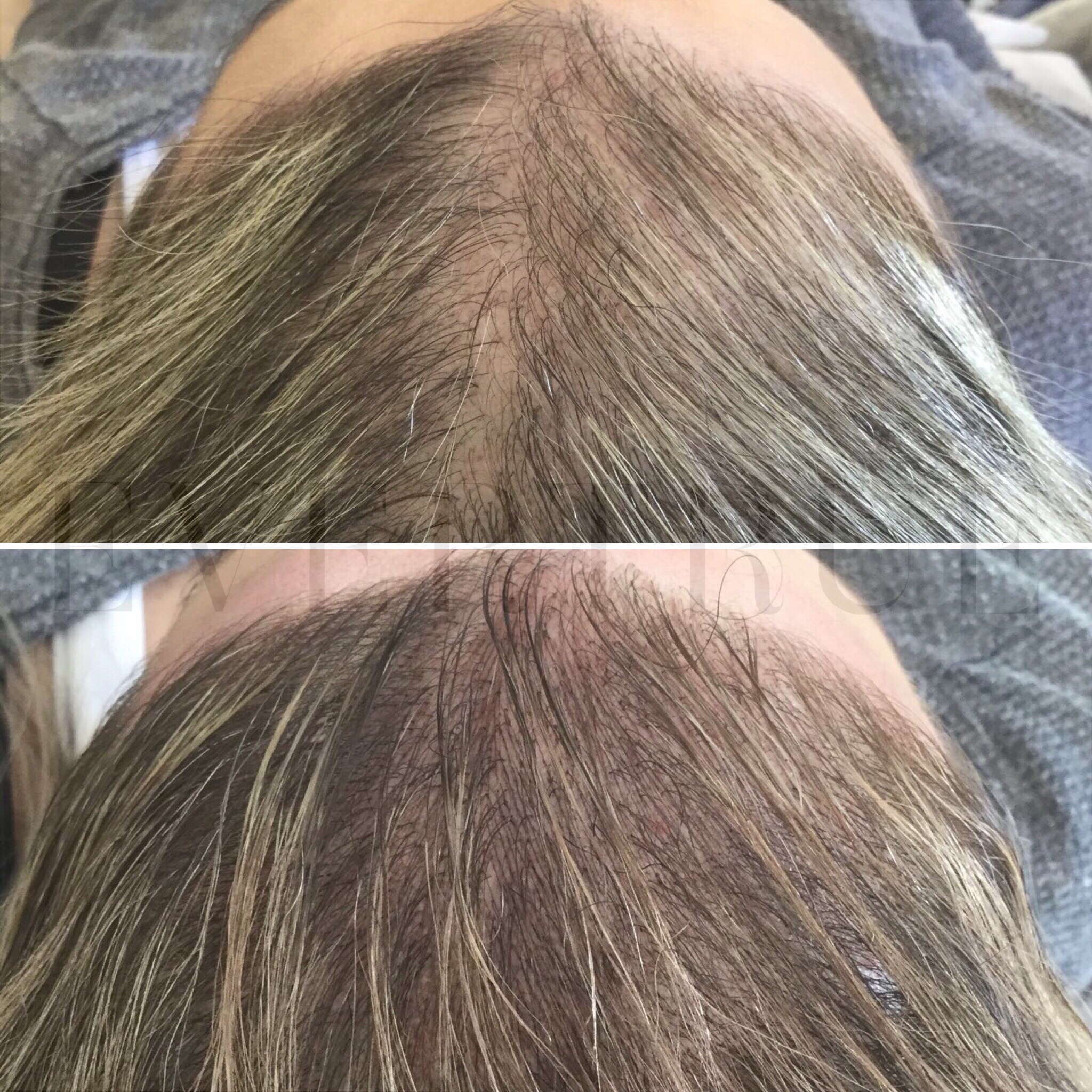 Comparison of a person's scalp before (top) and after (bottom) hair treatment, showing increased hair density and reduced visibility of scalp in the second image.