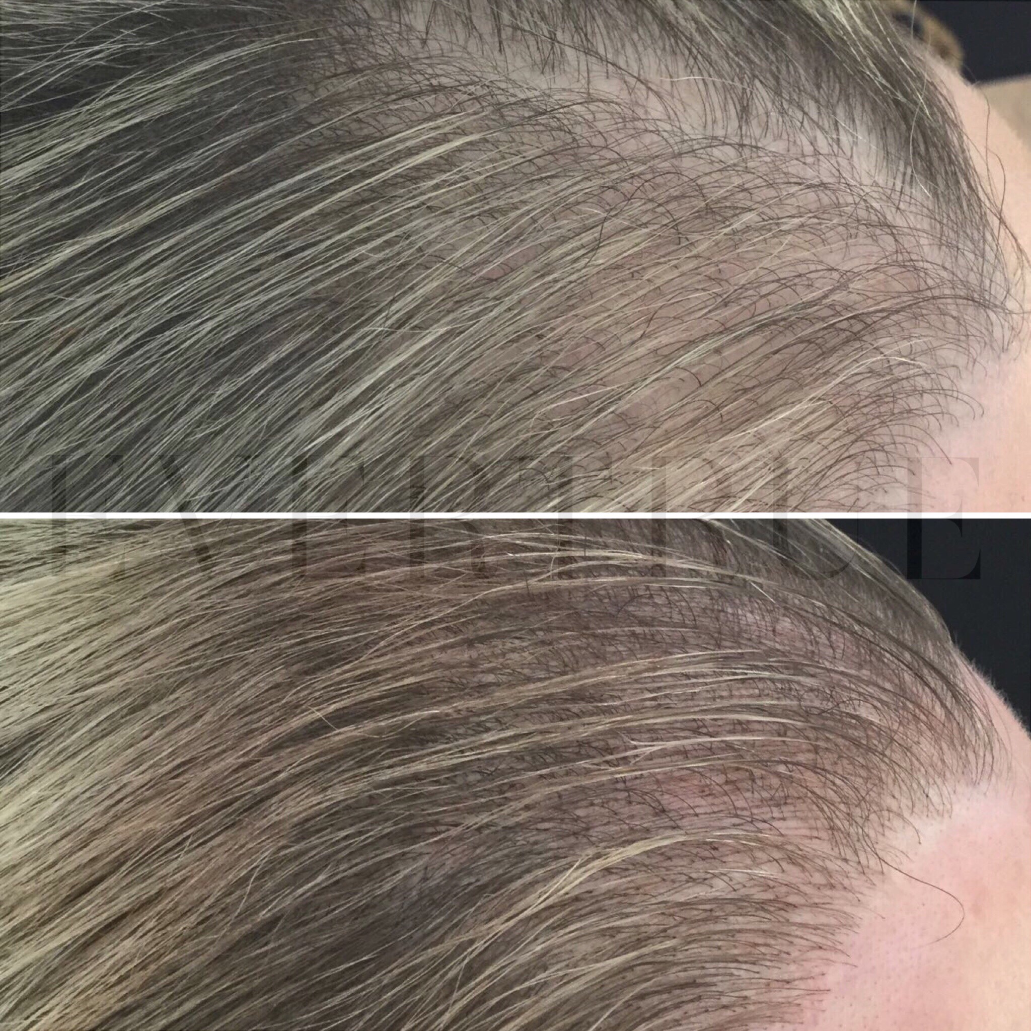 Two side-by-side close-up images of a person's scalp showing thinning hair in the top image and visibly fuller hair with less scalp showing in the bottom image.
